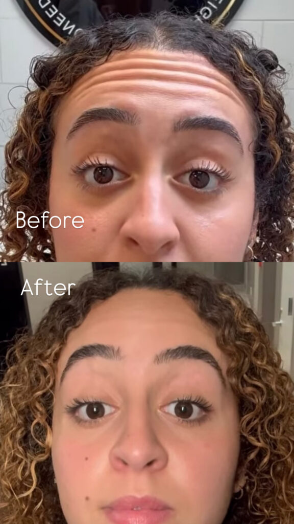 Botox Upper East Side NYC performed by an experienced medical provider
