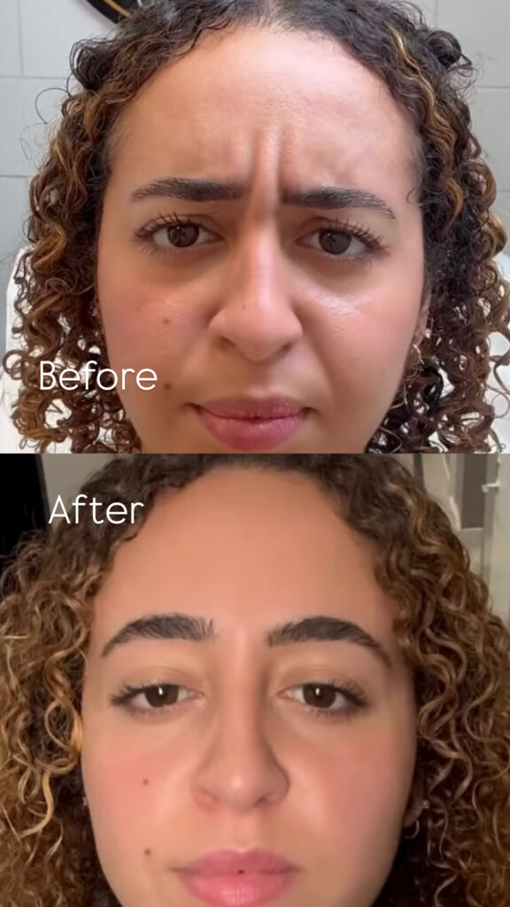 Botox Upper East Side NYC performed by an experienced medical provider
