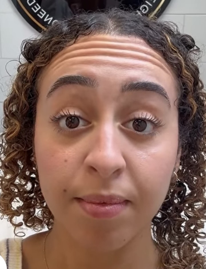 Botox for crows feet Upper East Side NYC
