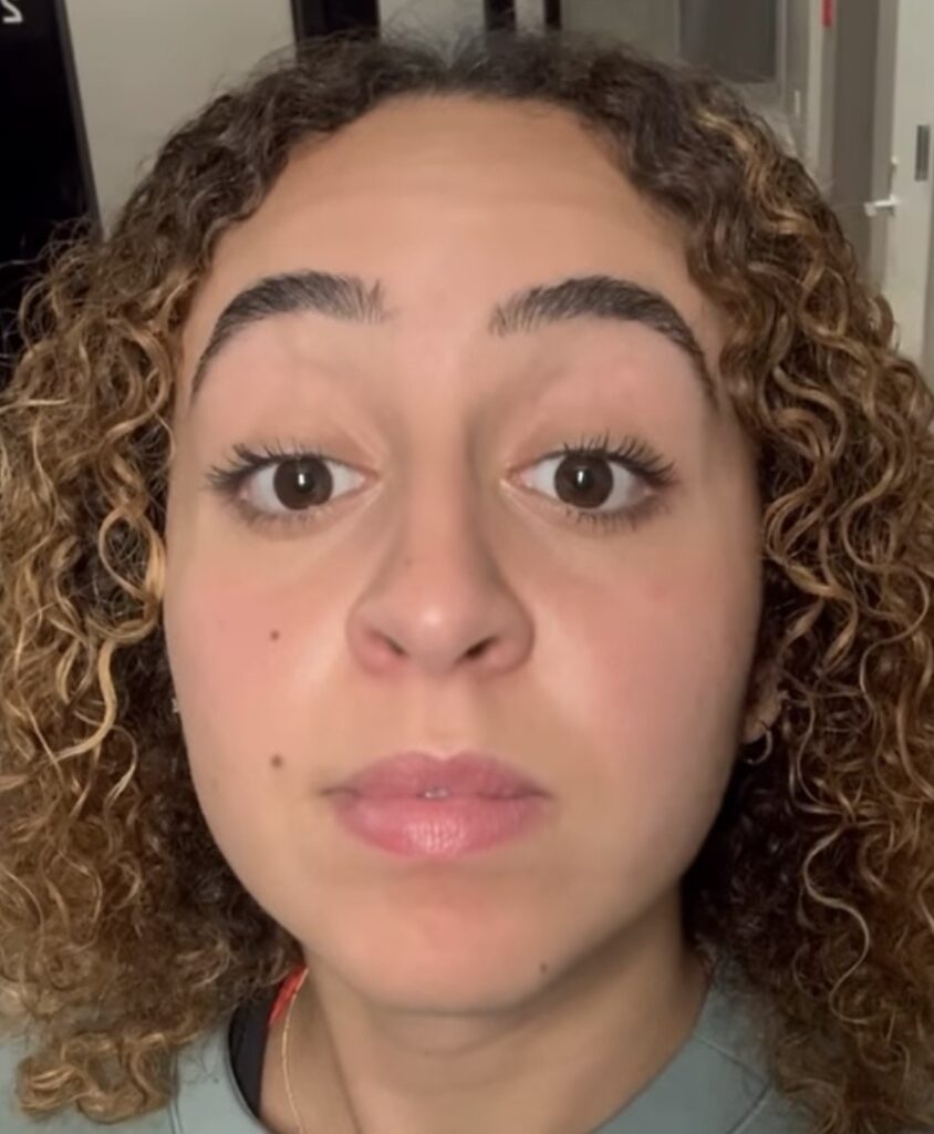 Botox for crows feet Upper East Side NYC
