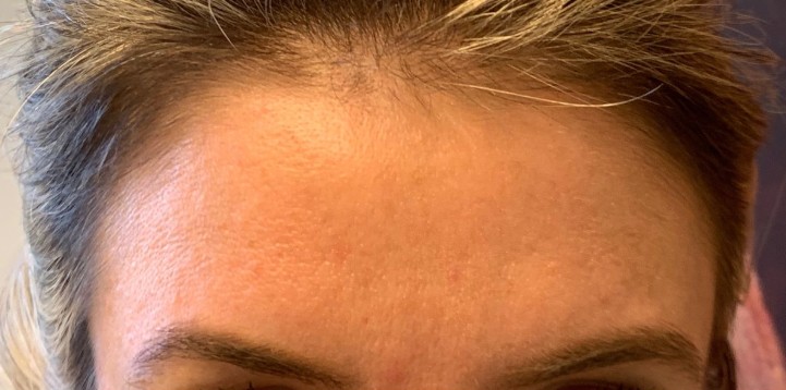 Frown Lines Botox in Upper East Side