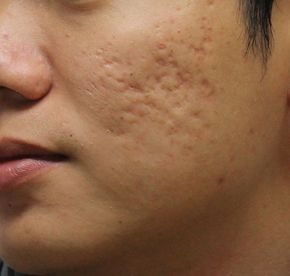 Acne Scar Treatment